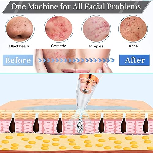 Miniatura 5 de Aspiradora removedor de puntos negros, removedor de cabeza negra para cara, extractor de puntos negros con 3 potencia de succión, 6 sondas de