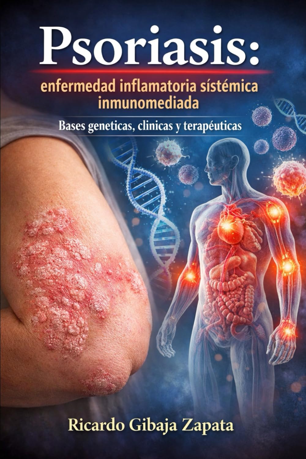 Psoriasis: enfermedad inflamatoria sistémica inmunomediada. Bases genéticas, clínicas y terapéuticas