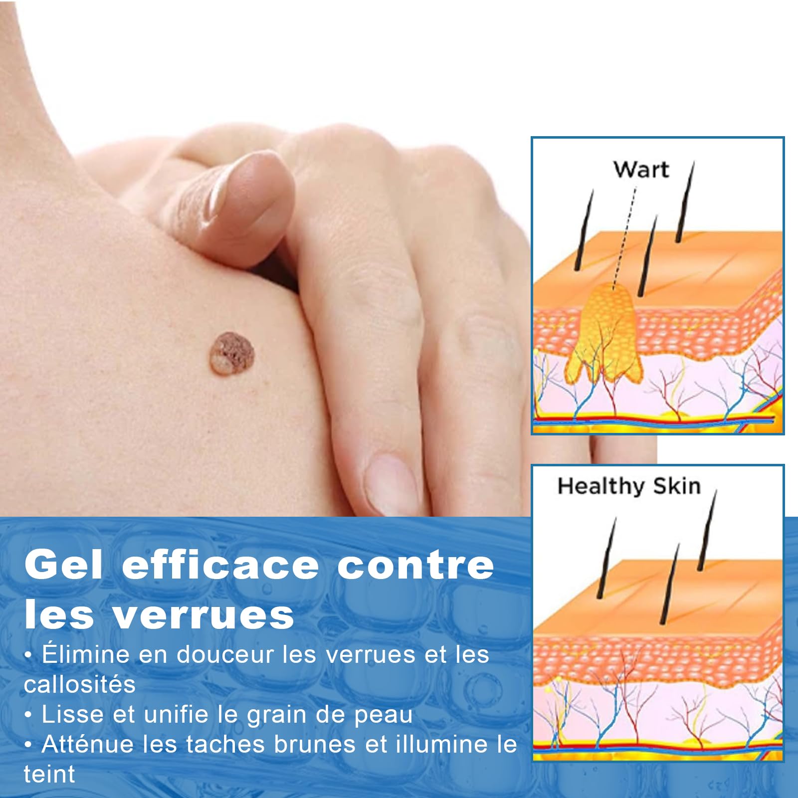 Gel anti-verrues 20g pour le Corps et les Mains
