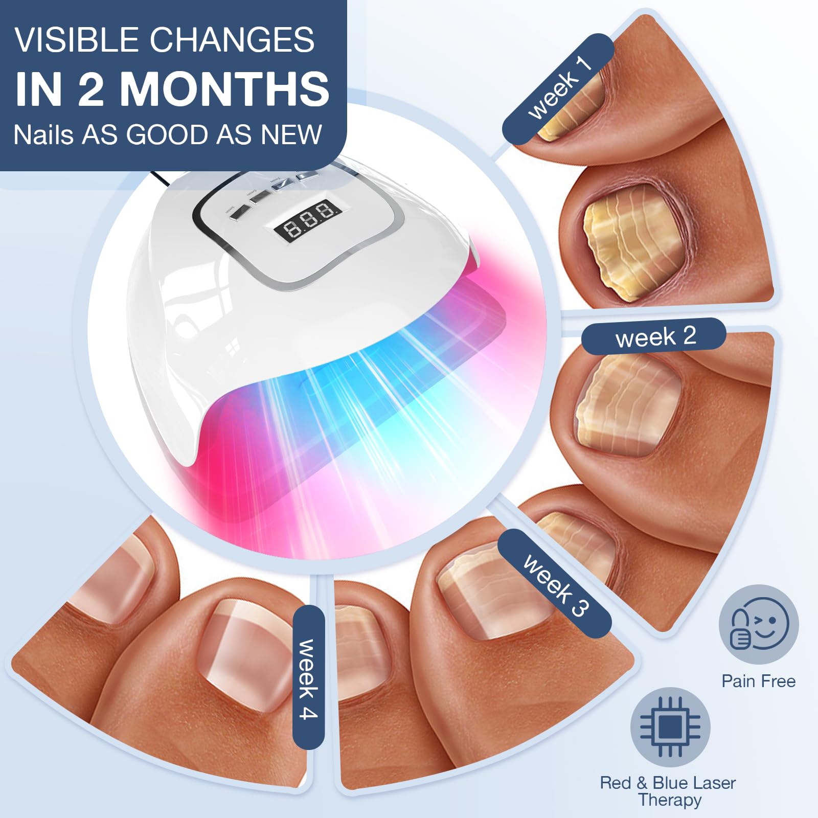 iKeener Dispositivo laser per funghi del chiodo, approvato dalla FDA, pulizia delle unghie e onicomicosi, rimozione funghi con luce blu 15 x 470 nm + 30 x 650 nm luce rossa, sessioni