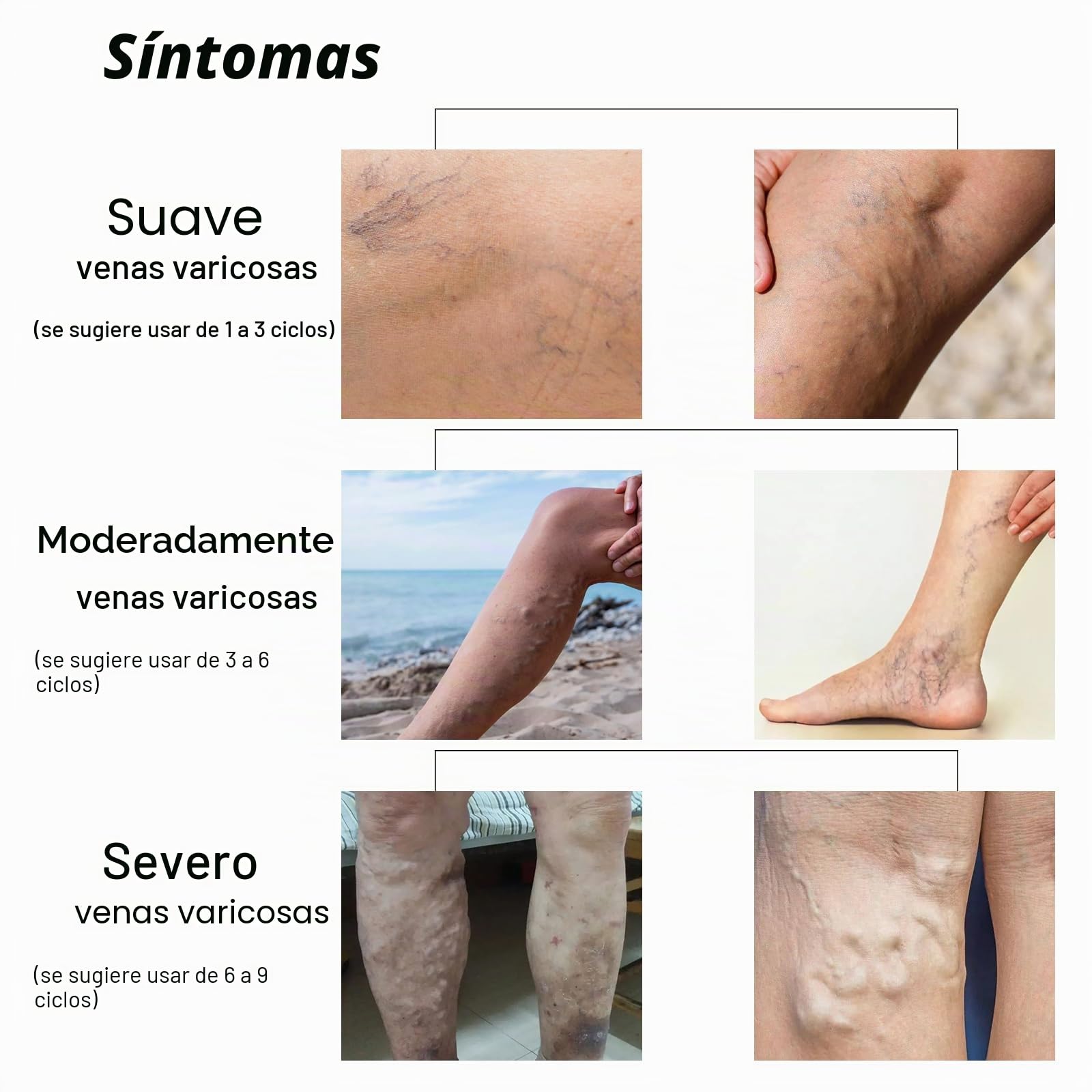 Crema Reparadora de Patas de Araña, Varicoso Vena Calmante Pierna Crema, Crema para Venas de araña para Uso Externo, Eliminación de Arañas para el Dolor de Piernas y Muslos