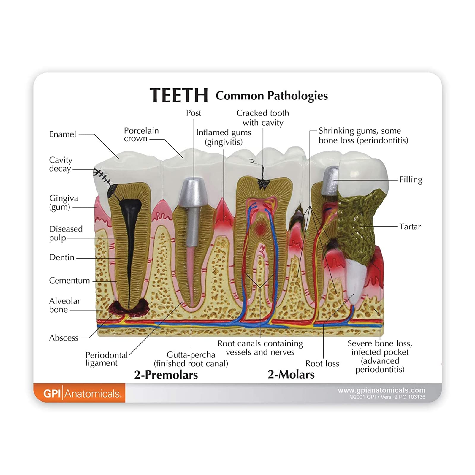 Dentalmodell, Anatomie des menschlichen Körpers, Nachbildung von Zähnen mit/häufigen Pathologien, für die Zahnarztpraxis, Lehrmittel, Anatomicals