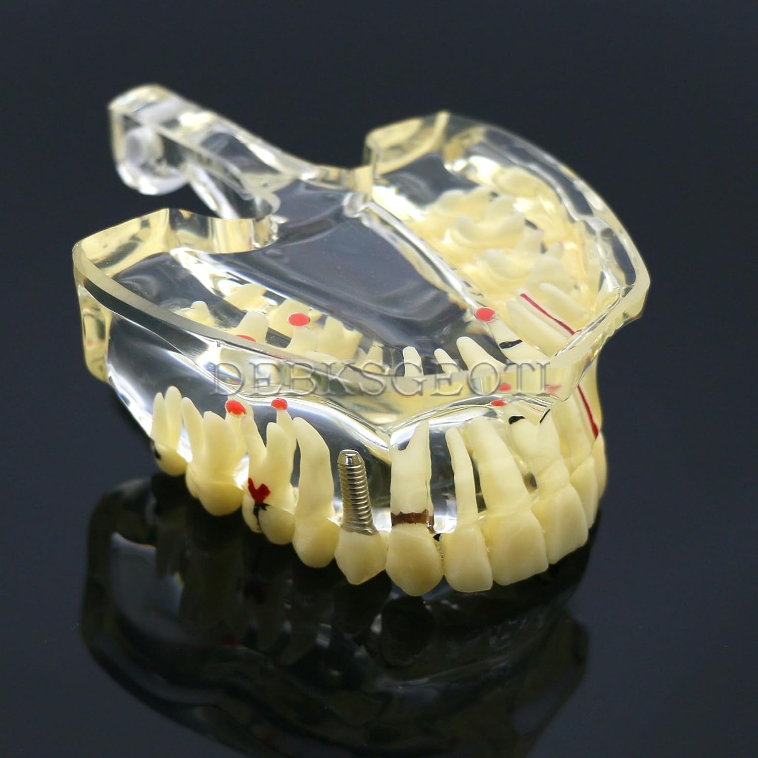 Dental Typodont Model Pathological Tooth Models Caries, Dental Stones, Cysts, Impacted Wisdom Teeth, Implants, Periodontal Disease Display Educational Models M4001