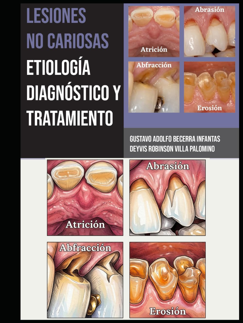 Lesiones no cariosas: etiología, diagnóstico y tratamiento