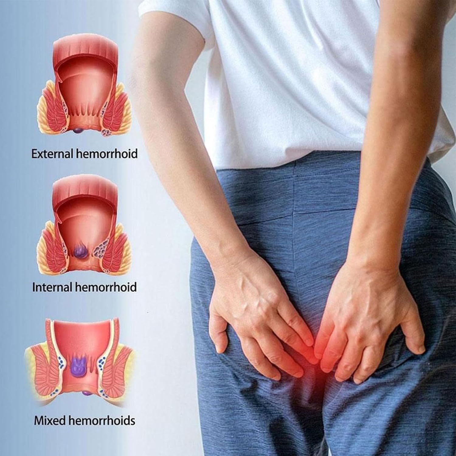 Hemorrhoids Cream，Hemorrhoid Ointment ，Natural Herbs Fast Acting Ingredients，Natural Hemorrhoid Ointment for Men and Women