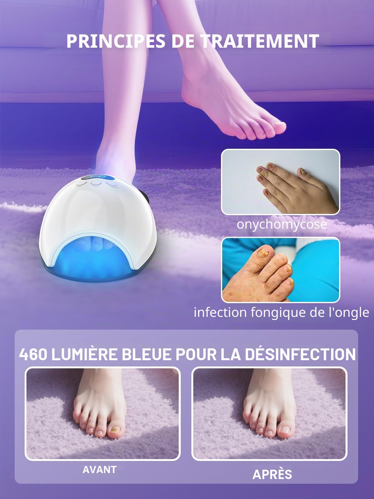 iKeener Appareil laser thérapeutique pour doigts et orteils, sessions 5/7/10 min, nettoyage laser ongles, onychomycose, lumière bleue 30 x 460 nm