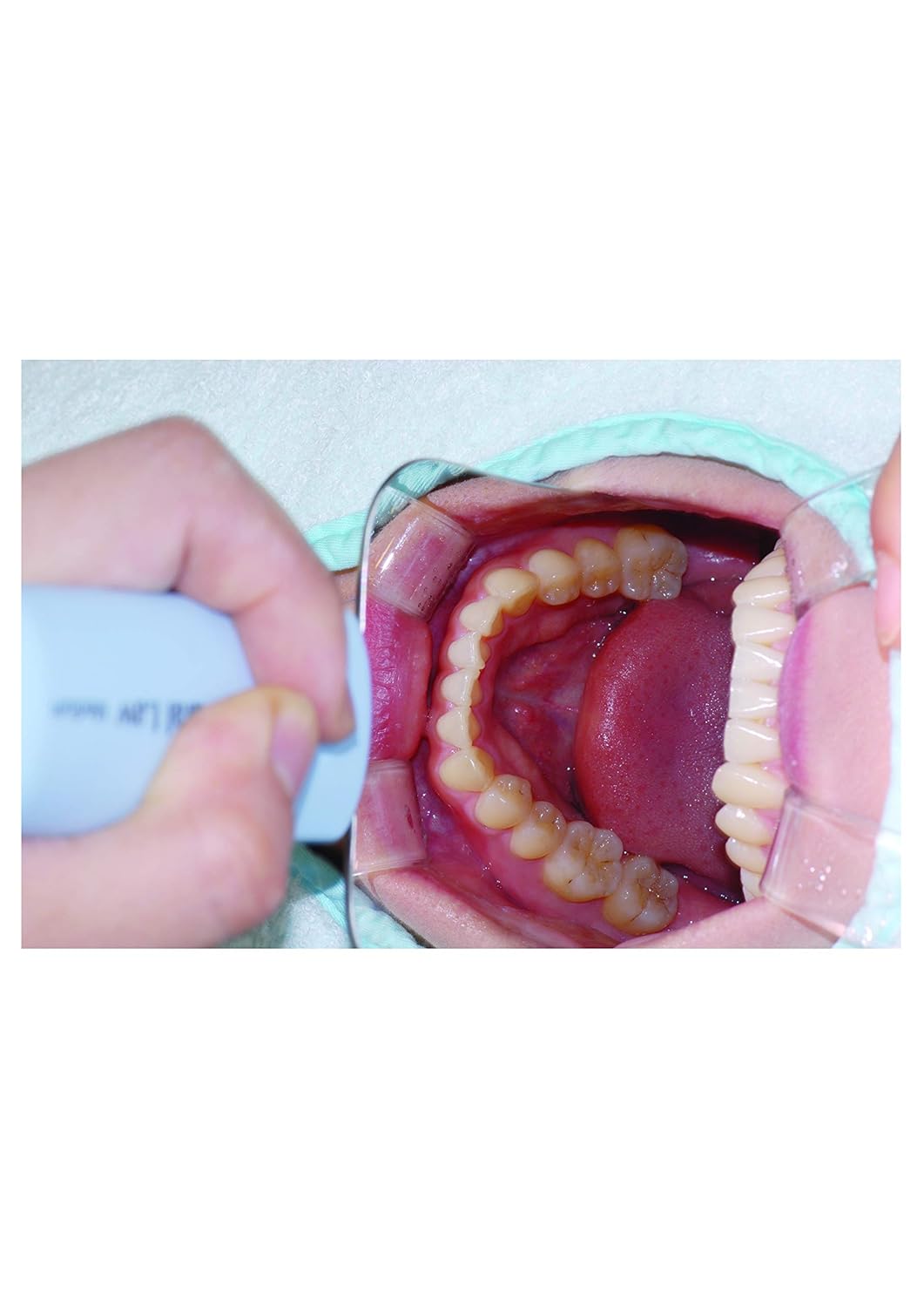 Buy OSUNG Intraoral Photography Dental Mirror with Handle (Occlusal