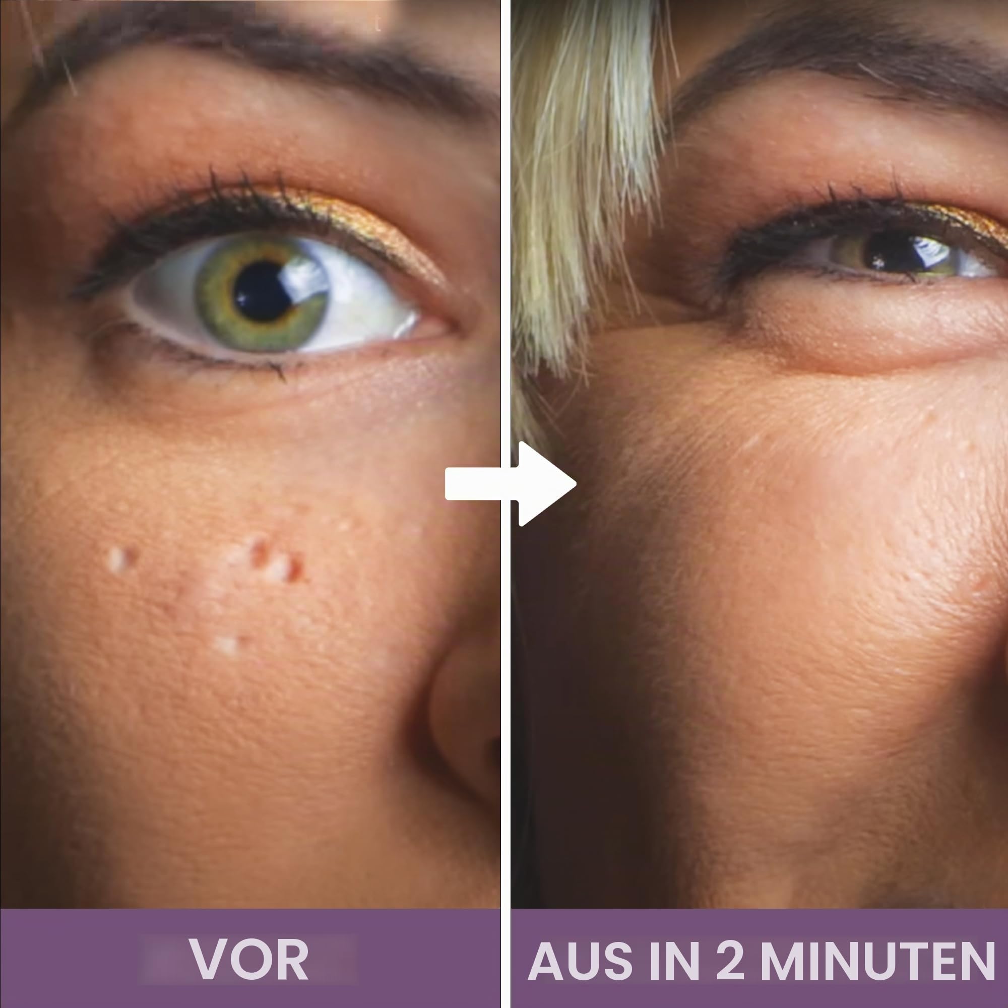 Dermaflage Narben Make-up Concealer, Aknennarben Filler, Narben Abdeckung, 1 Monatsvorrat