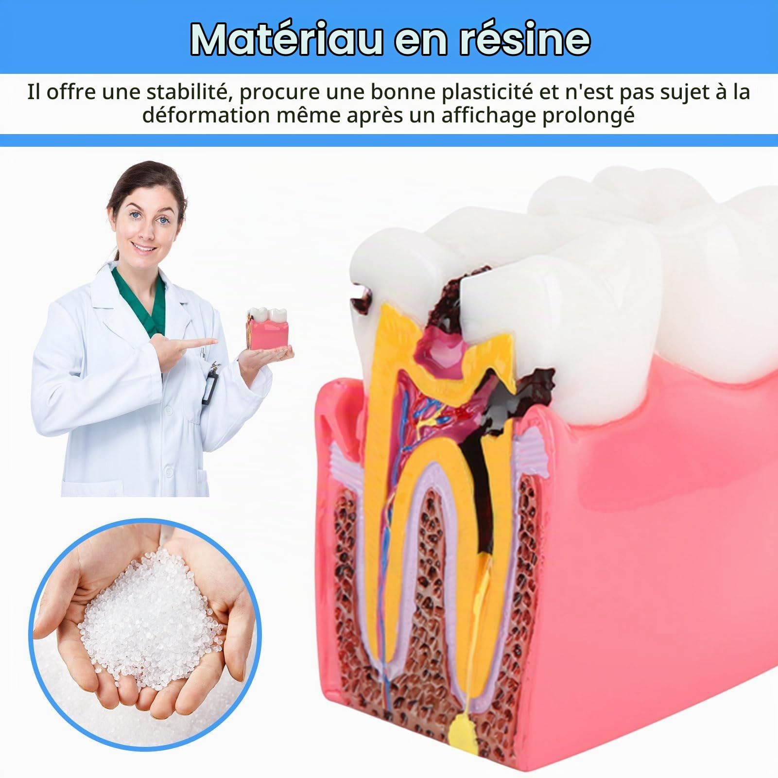 Agatige Modèle D'anatomie Dentaire, Modèles D'Étude De Comparaison De Caries Modèle De Dents D'Éducation À L'anatomie Dentaire De Dentiste Modèle De Développement De Caries Dentaires pour L'Éducation