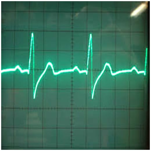 ECG