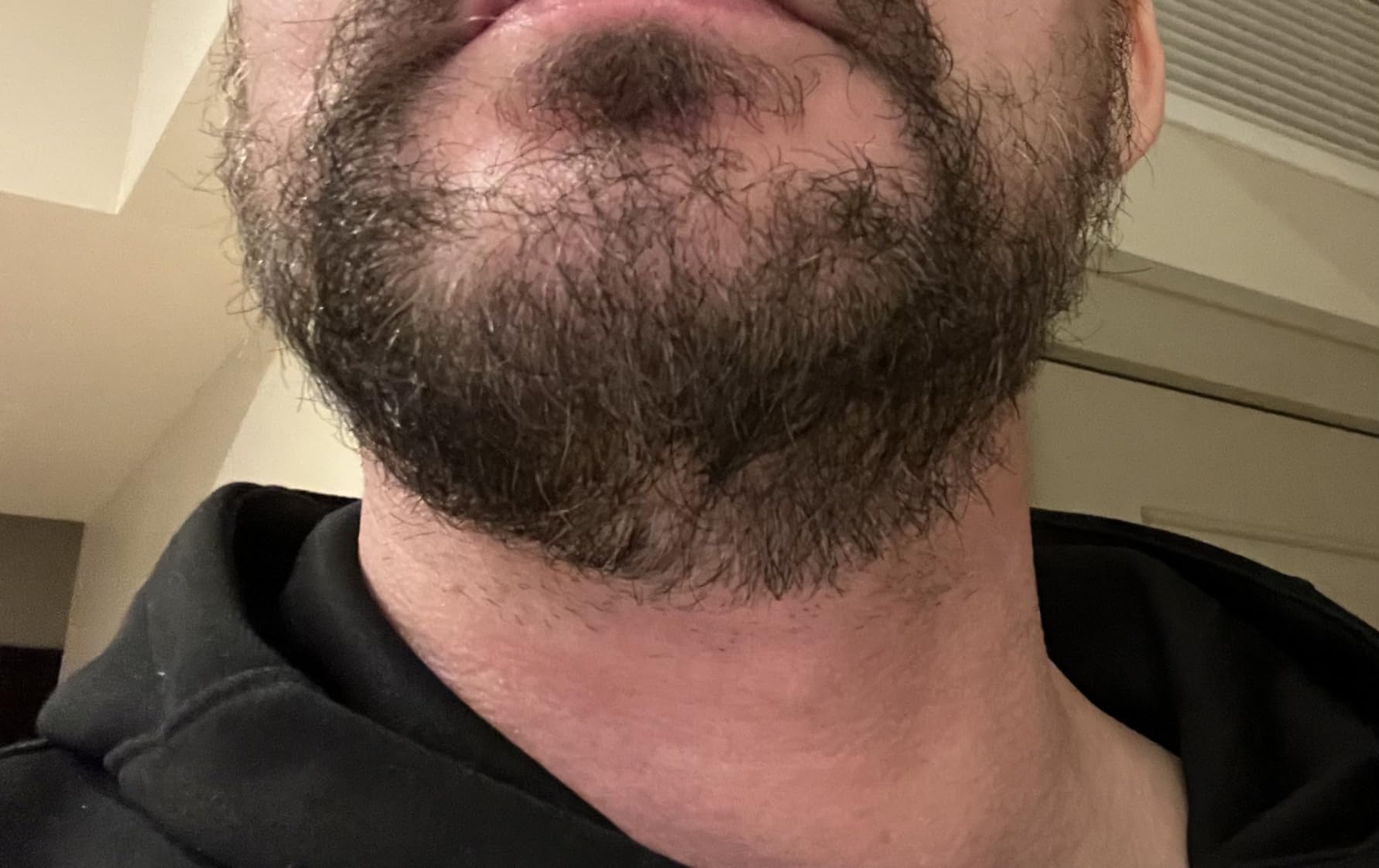 Worked well, definitely stings a bit for a while