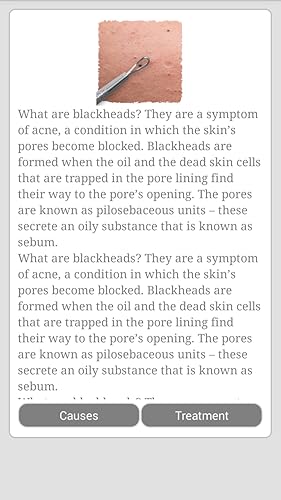 Get Rid Of Blackhead Naturally