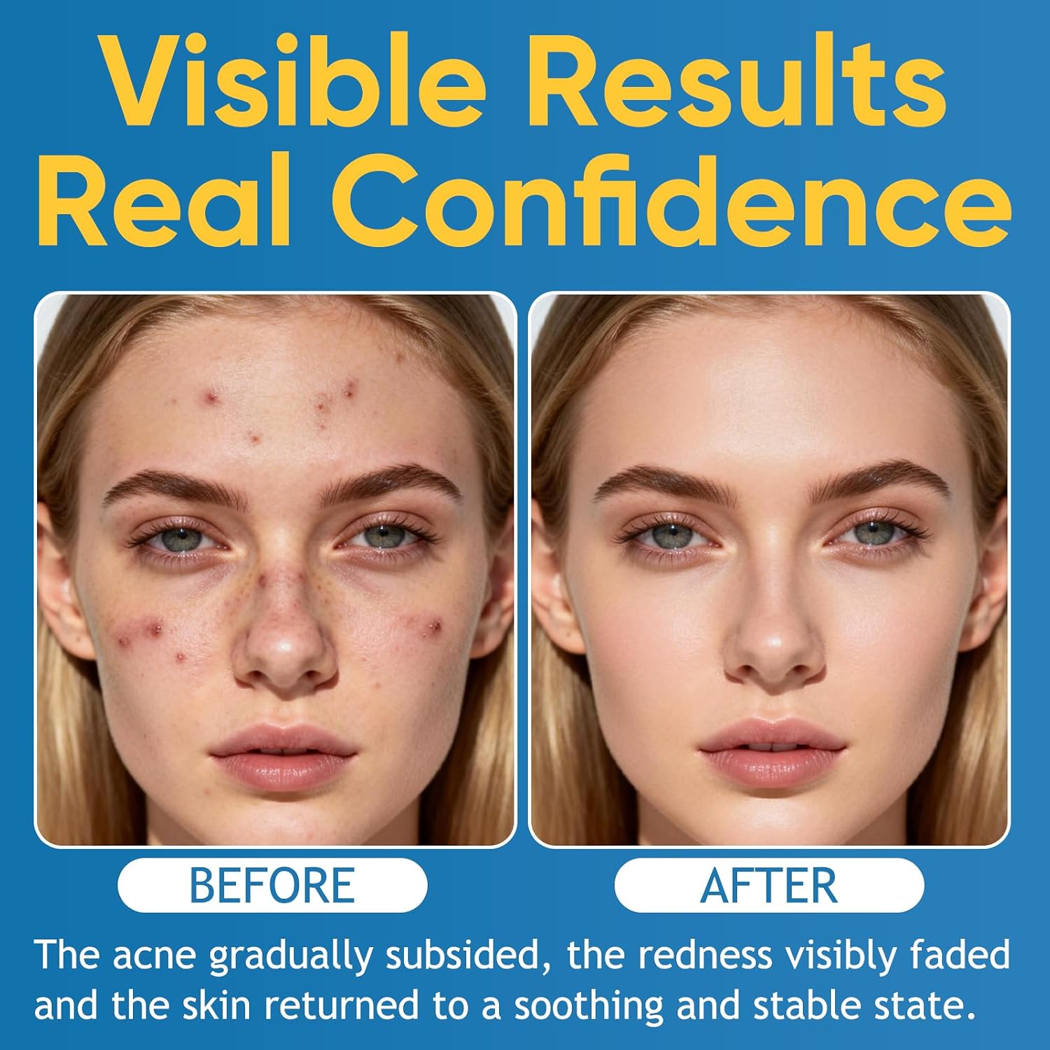 2pcs Acne & Redness Killer, Organics Acne Balm, Remove Skin Care Set Natural Plant Formula For All Skin Types