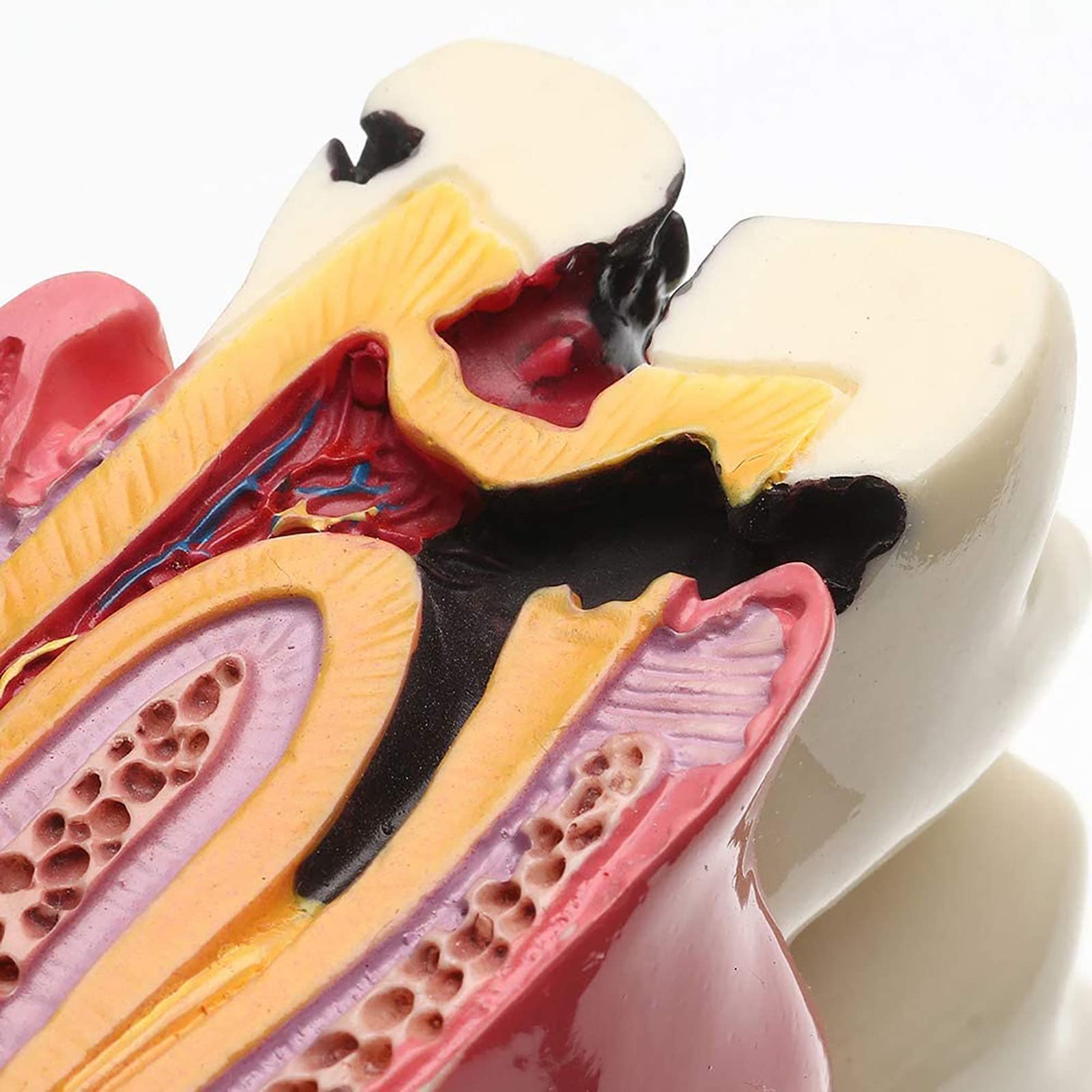 Modello di Dente con Carie Dentale, Modello di Denti Malati, Modello di Studio per pazienti odontoiatrici, Modello di Studio per confronto di Carie 6 Volte, Strumenti didattici