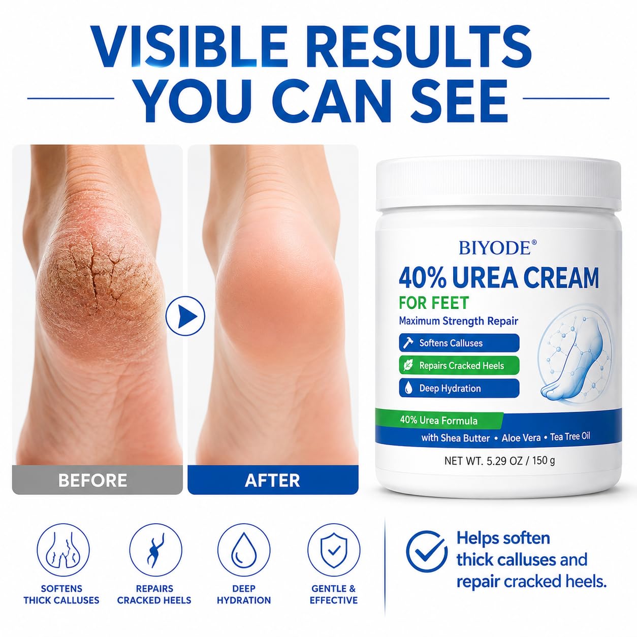40% Urea Foot Cream for Dry Feet – Intensive Moisturizing Foot Cream with Shea Butter, Aloe Vera & Tea Tree Oil – Softens Rough Skin & Calluses – Daily Foot Care for Smooth