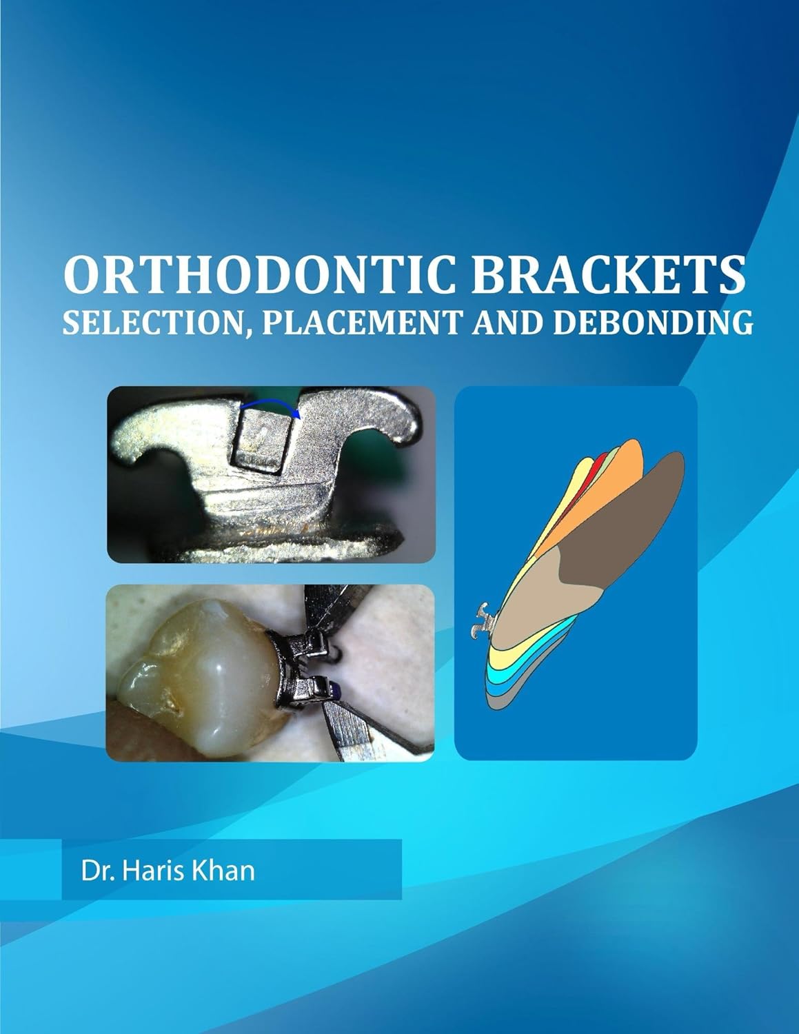 Orthodontic Brackets Selection,Placement and Debonding