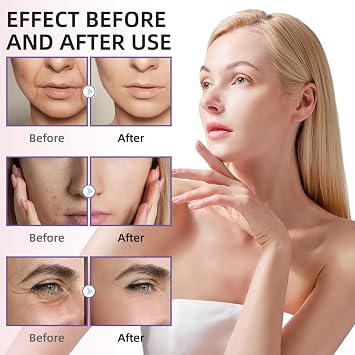 Milia Removal Cream&Whitehead Remover,Gentle Spot Treatment for Face,Moisturizing Anti-Aging Cream for Teenagers&Adults,Natural Pimple&Milia Treatment Under Eye,Refreshing and Not Greasy,Easy to Use