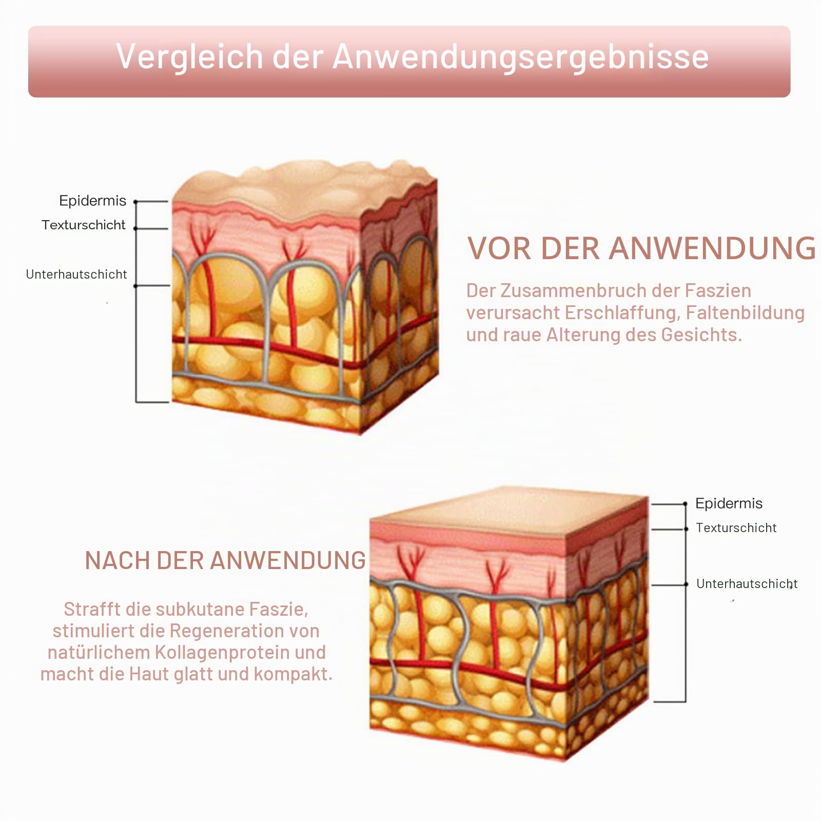 Mini Hifu Gesichtshautpflege Maschine, Hochfrequenz Falten Entfernen Hautpflege Gerät, Ultraschall-Schönheitsgerät Zur Gesichtsstraffung