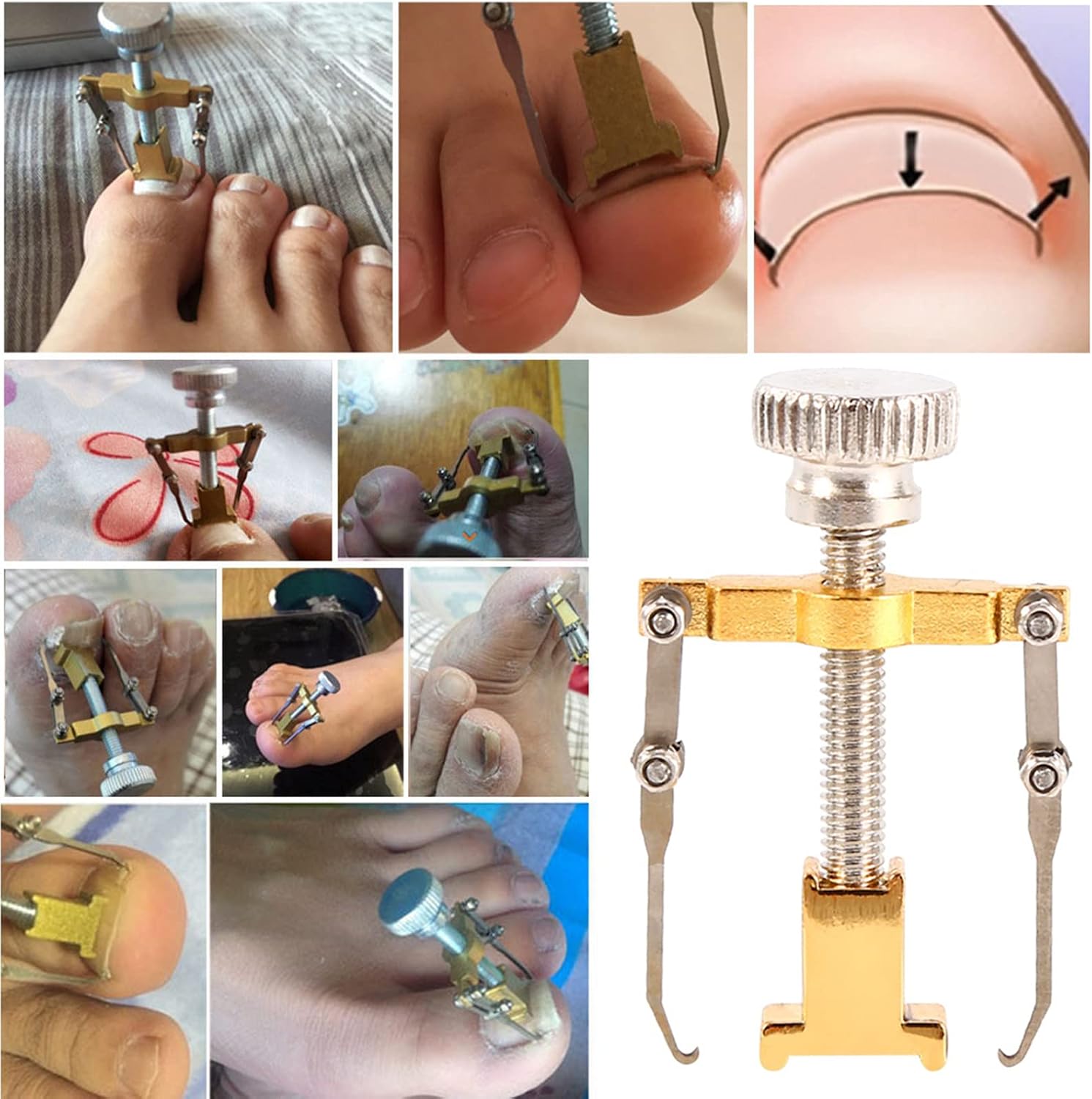 Ingrowing Nail Corrector, Professional Ingrown Toe Recover Correction Fixer Toenail ingrown toenail Treatment Manicure Pedicure Nails Care Tool Paronychia Treatment Foot Stainless