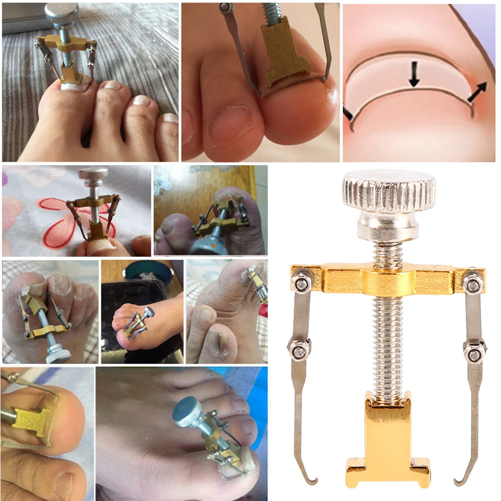 Saluaqui Ingrown Toenail Fixer, Professional Manicure Pedicure Tool with Lever Mechanics for Nail Growth Correction