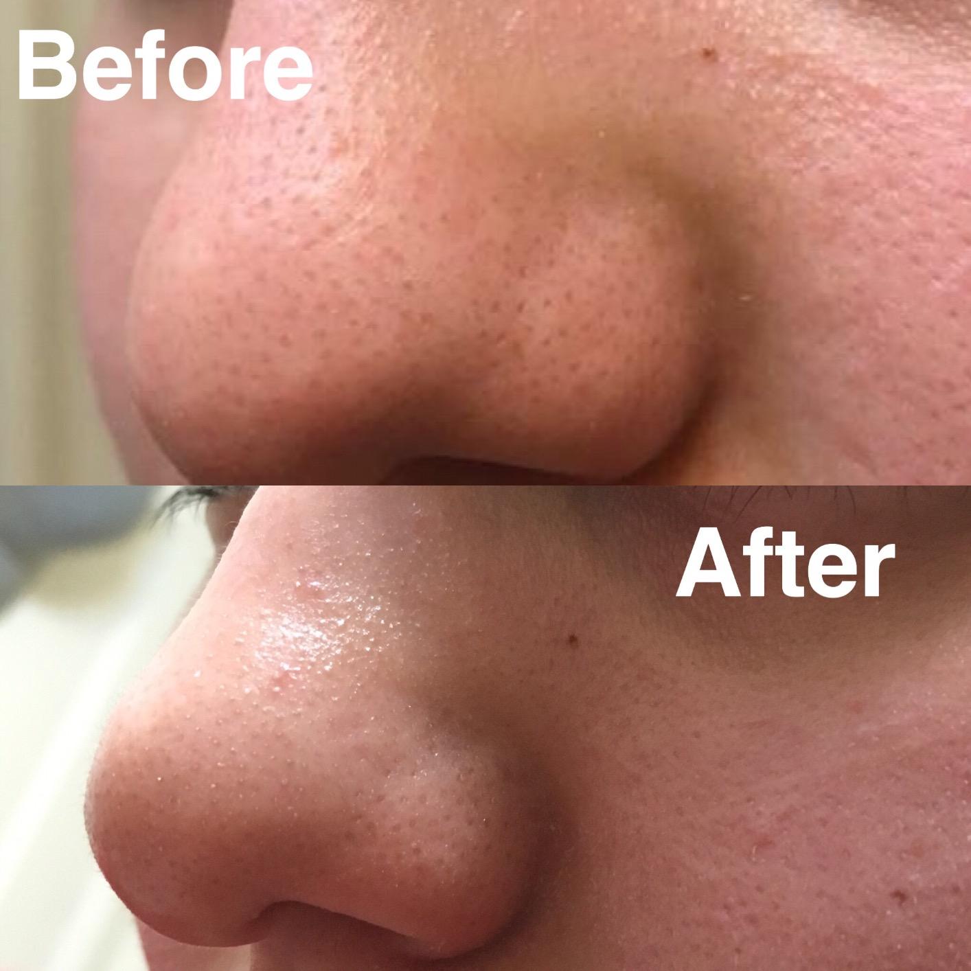 Nip+Fab Nip + Fab Glycolic Acid Fix Serum for Face with Aloe Vera, AHA Anti-Aging for Fine Lines and Wrinkles, Refine Minimize Pores, Skin Toning, 1.01 Ounce