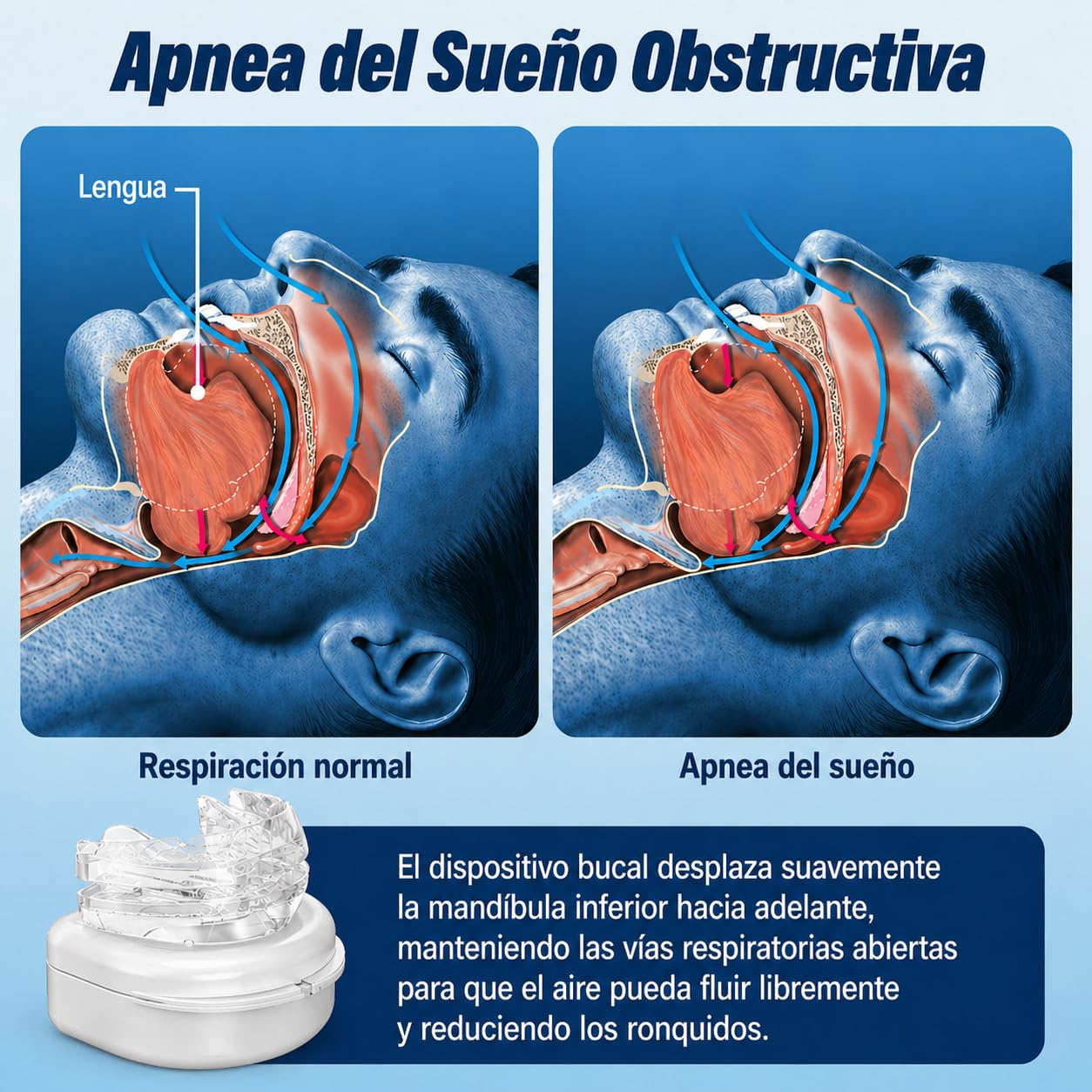 Avanzado Dispositivo Antironquidos – Férula Anti Ronquidos para Dormir, Solución Eficaz para Combatir los Ronquidos y Mejorar la Respiración Nocturna, Blanco Transparente