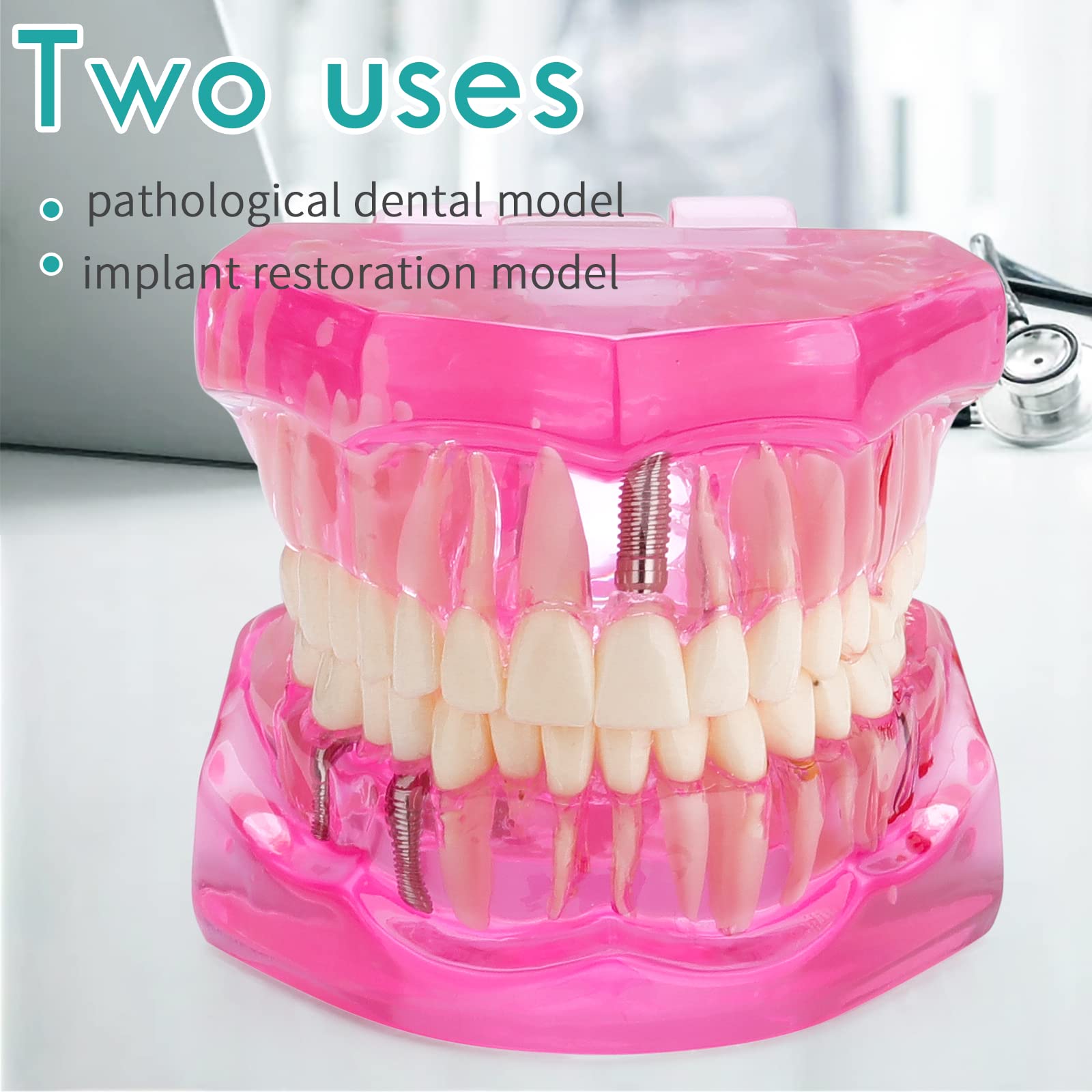 LVCHEN Transparent Dental Implant Teeth Model - Transparent Disease Teeth Model Pathological Tooth Model with Removable Teeth for Dental Study and Education