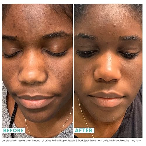 Miniatura 2 de Urban Skin Rx® Retinol - Suero facial de reparación rápida + tratamiento de manchas oscuras, se dirige a líneas finas, hiperpigmentación e