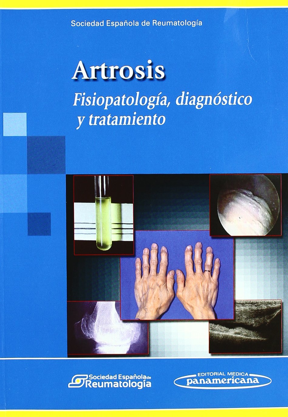 Artrosis