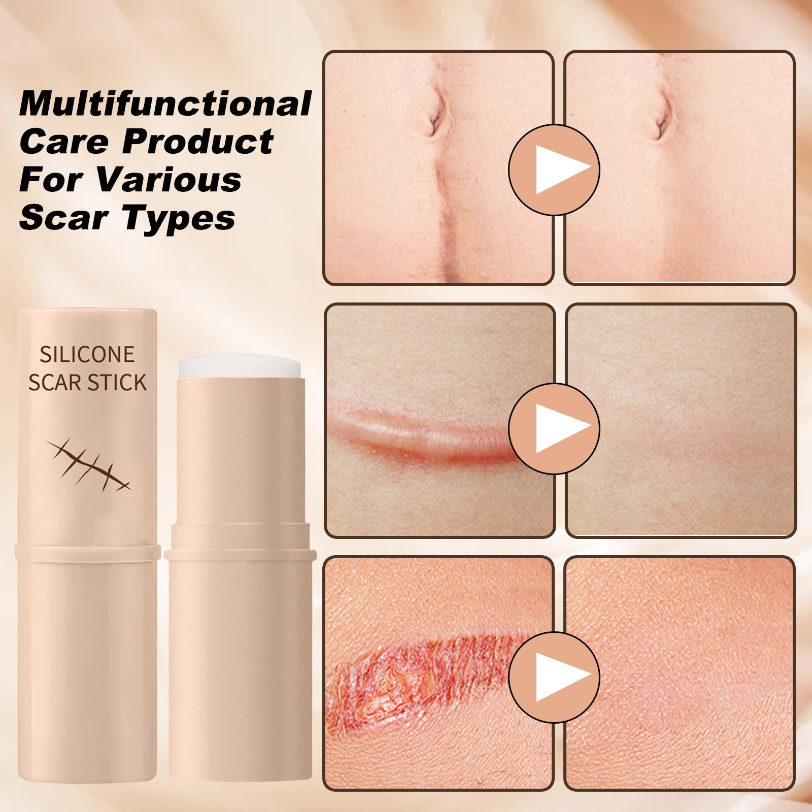 Scar Solutions - Stick per cicatrici in silicone, realizzato in 60% silicone, leggero e facile da applicare, delicato su tutti i tipi di pelle (2 pezzi)