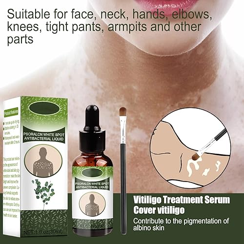 Miniatura 2 de Crema de vitíligo, ungüento para tratamiento de vitíligo para mejorar la pigmentación de la piel y reducir la leucoplasia cubierta segura portátil