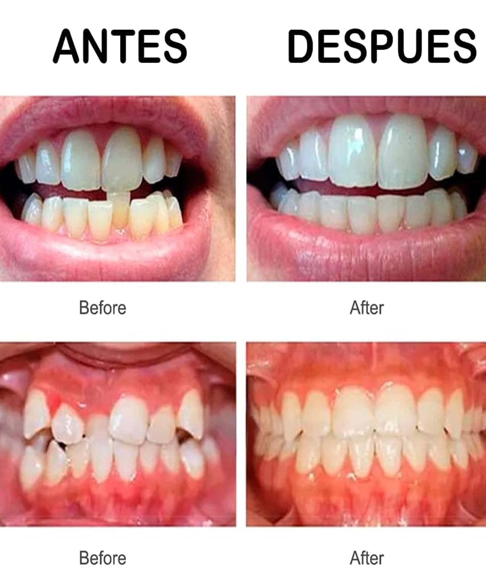 Teeth Aligners for Straightening Teeth, Night Guards for Teeth Grinding, Transparent Teeth Aligner for Minor Dental Alignment - Image 4 thumbnail