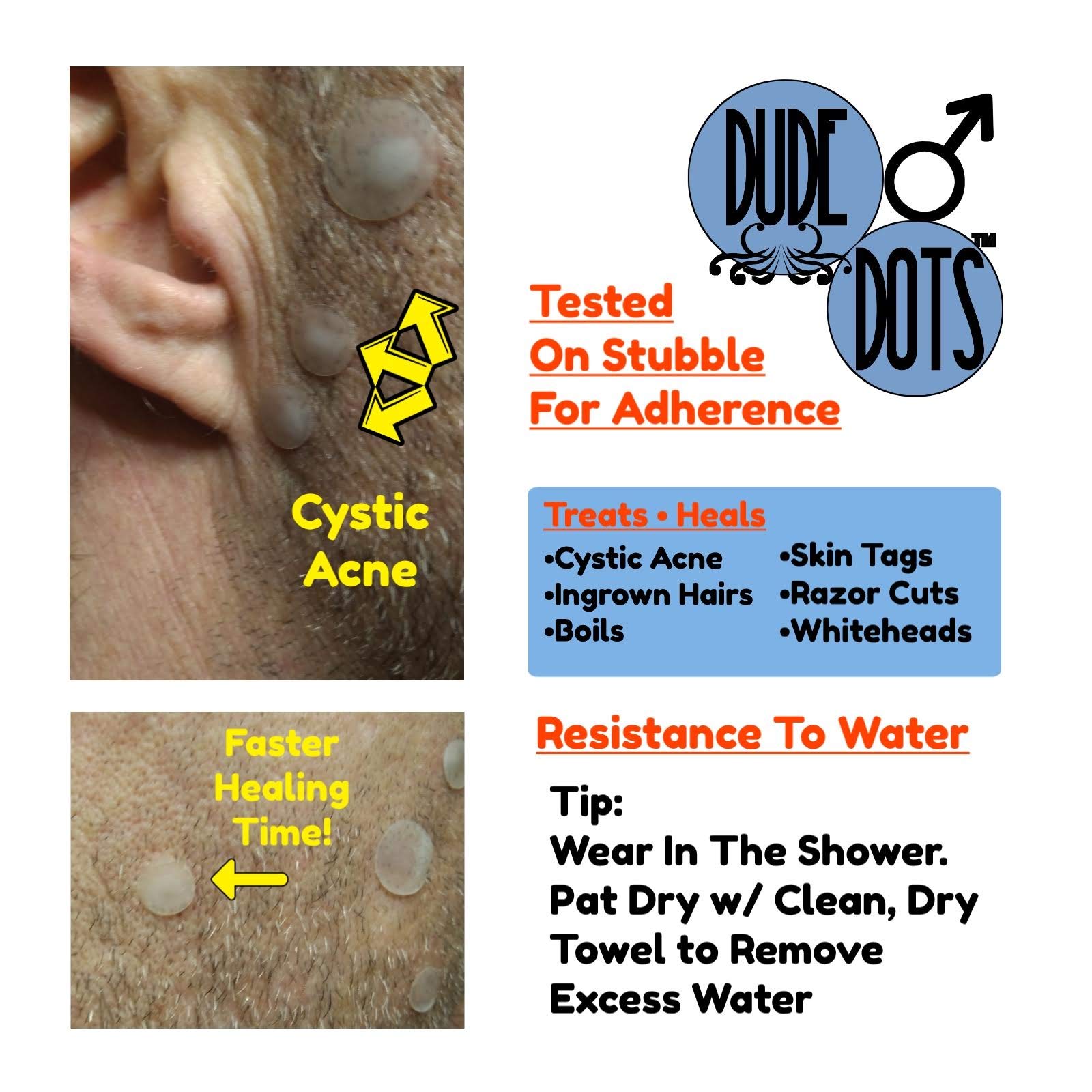 Amazon.com: [DUDE DOTS] Acne Healing Pimple Patches, Cystic Acne Patch, Ingrown  Hair, Boils, Bug Bite Bandage, Mask Acne, Maskne, FACE Zit Stickers,  #tads20 : Beauty & Personal Care