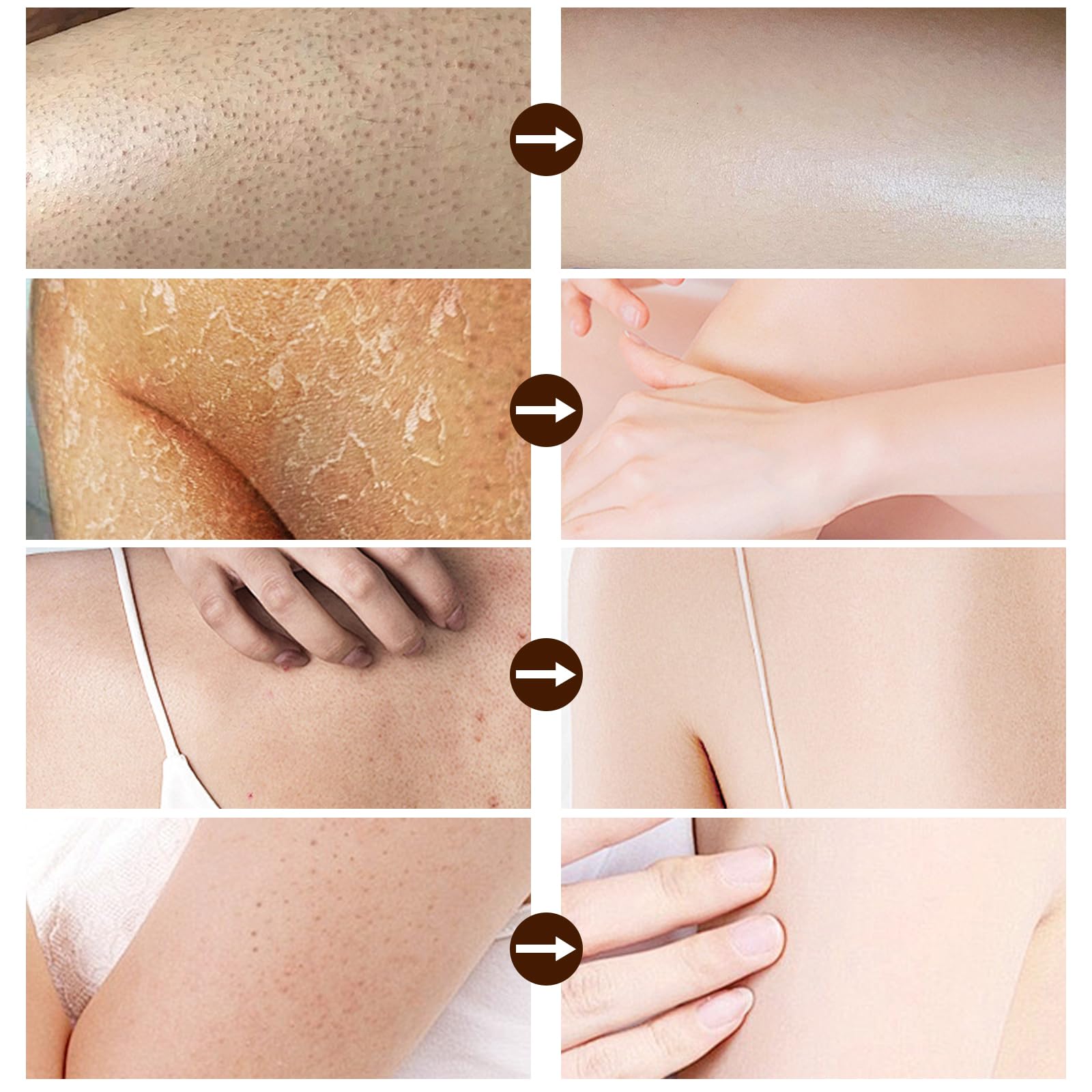 AOPEIBOTO Strawberry Legs Treatment, Skin Smoothing Cream for Chicken Skin Treatment Fades And Eliminates Strawberry Spots - Image 2