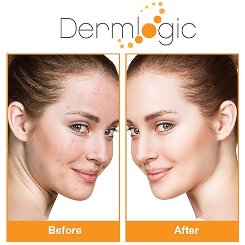 Miniatura 8 de Almohadillas de tratamiento para el acné: contiene ácido salicílico, glicólico y láctico para la cara y el cuerpo. Limpia los poros obstruidos, la