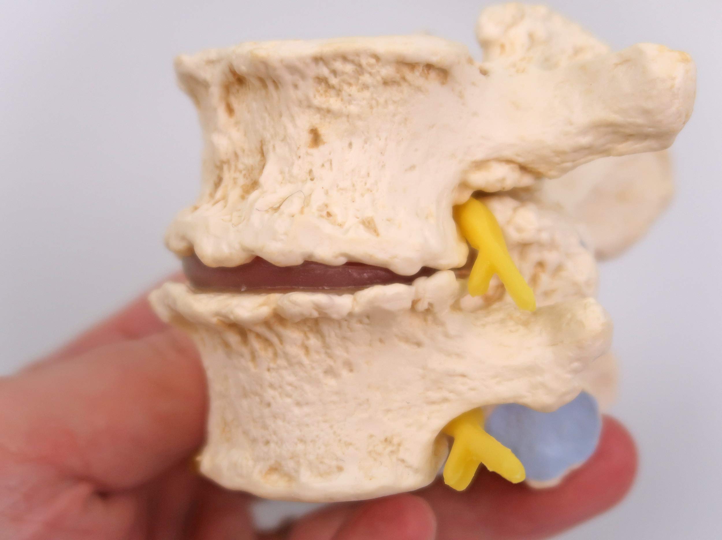 3B Scientific A795 Stadi dell'Ernia del Disco Intervertebrale e Degenerazione della Vertebra + software gratuito di anatomia - 3B Smart Anatomy