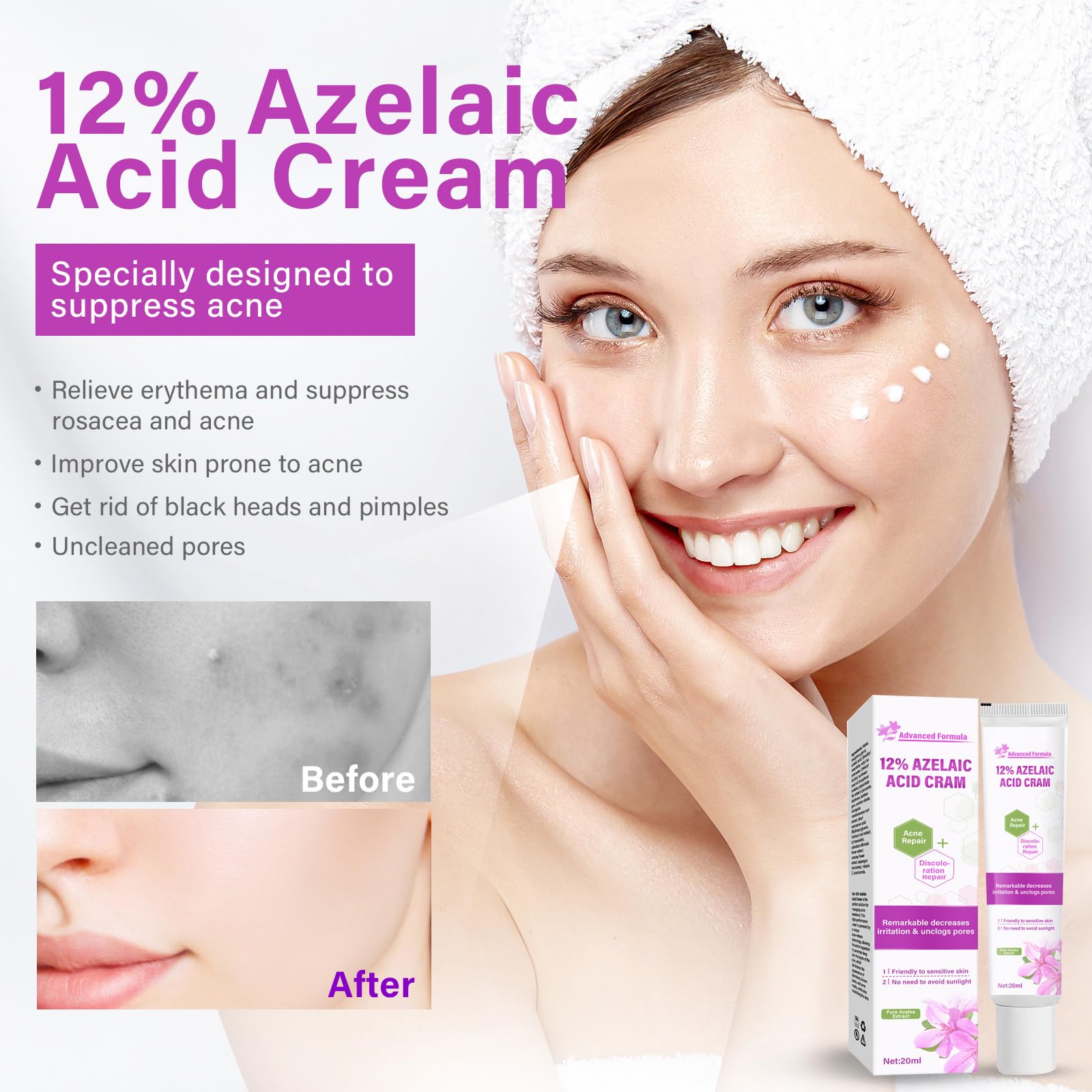 Siero Al 12% Di Acido Azelaico, Combatte Acne E Brufoli, Brufoli Invisibili, Libera I Pori, Riduce Significativamente L'Irritazione, Siero Antiacne Per La Pelle, 1 Oz