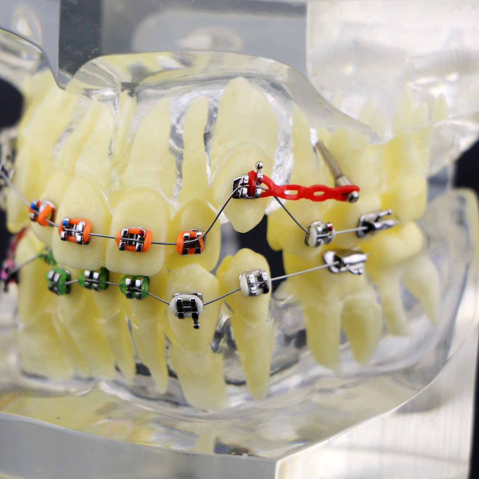 Kieferorthopädisches Zahnmodell, Kieferorthopädisches Zahnbehandlungs-Malokklusionsmodell mit Klammern Kettendraht