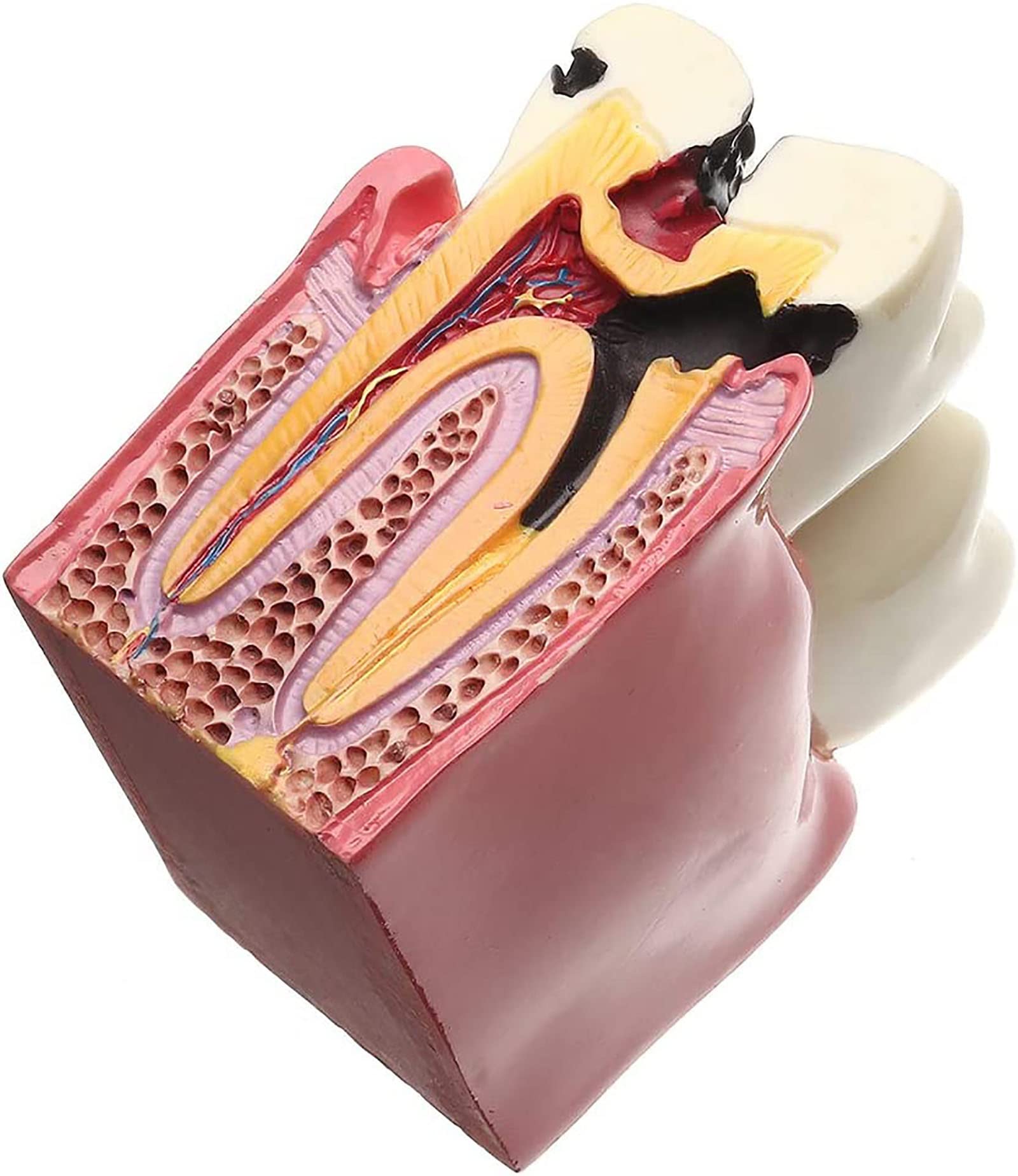 Modello di Dente con Carie Dentale, Modello di Denti Malati, Modello di Studio per pazienti odontoiatrici, Modello di Studio per confronto di Carie 6 Volte, Strumenti didattici