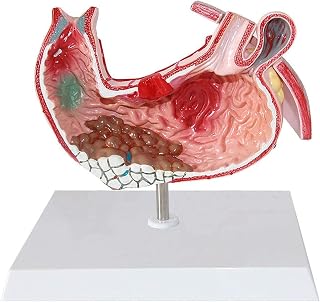 Study Model Human Stomach Anatomical Model - Gastritis Model Gastric Lesion Model - Medical Teaching Training Aid SaiFei