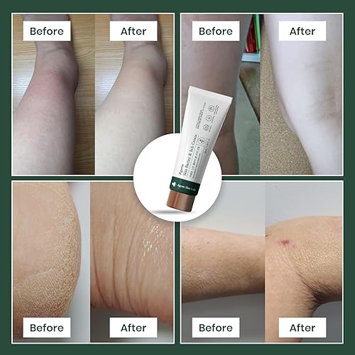 Miniatura 5 de Crema antipicazón, barrera cutánea y para aliviar la picazón para pieles sensibles y secas, cuidado de problemas, calmante, hidratante, purificante,