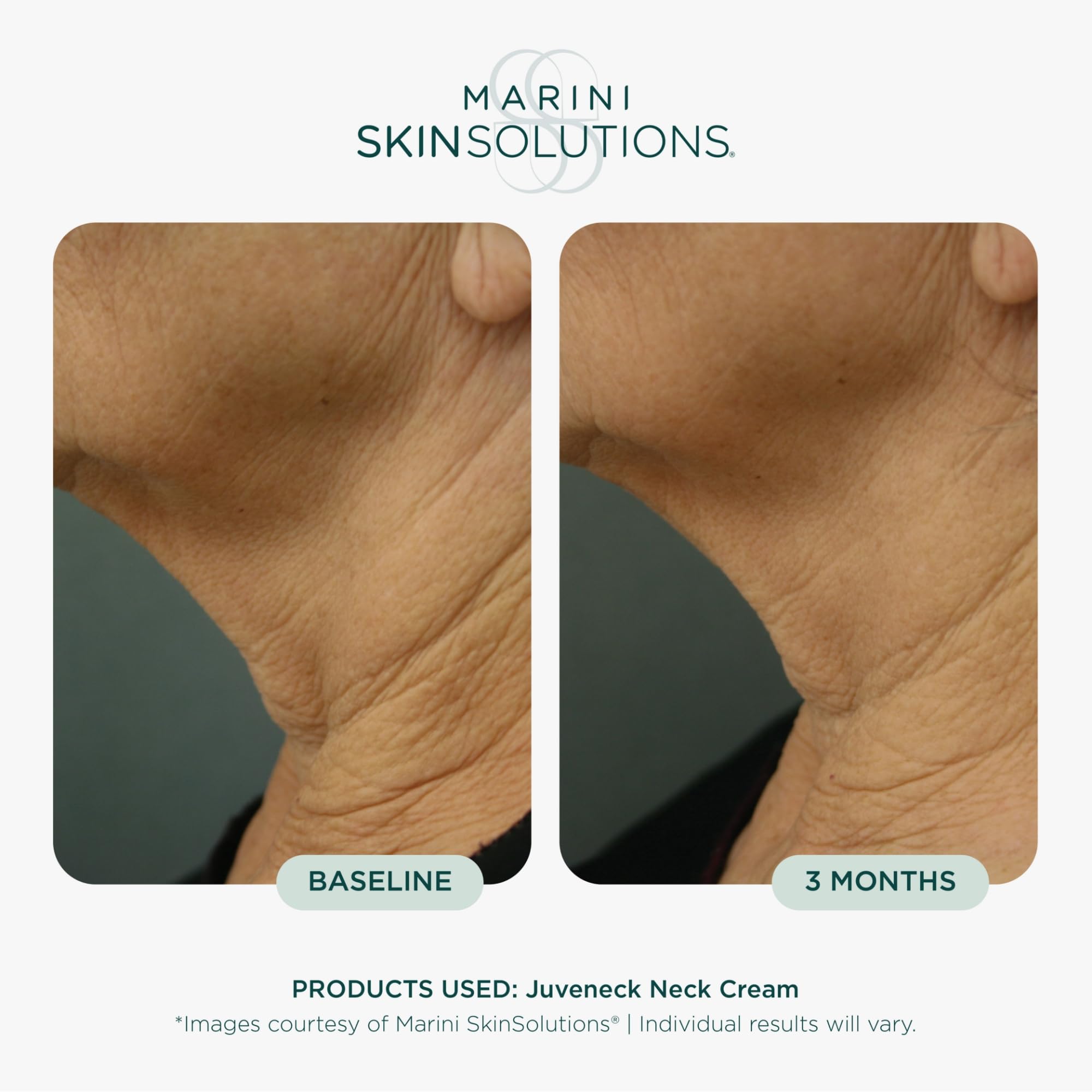 Amazon.com: Marini SkinSolutions Juveneck Neck Cream - 1.7 oz