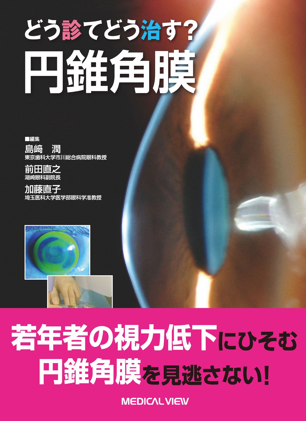 角膜疾患 外来でこう診てこう治せ 改訂第2版　【裁断済み】 角膜疾患−外来でこう診てこう治せ | 木下 茂 |本 | 通販 | Amazon
