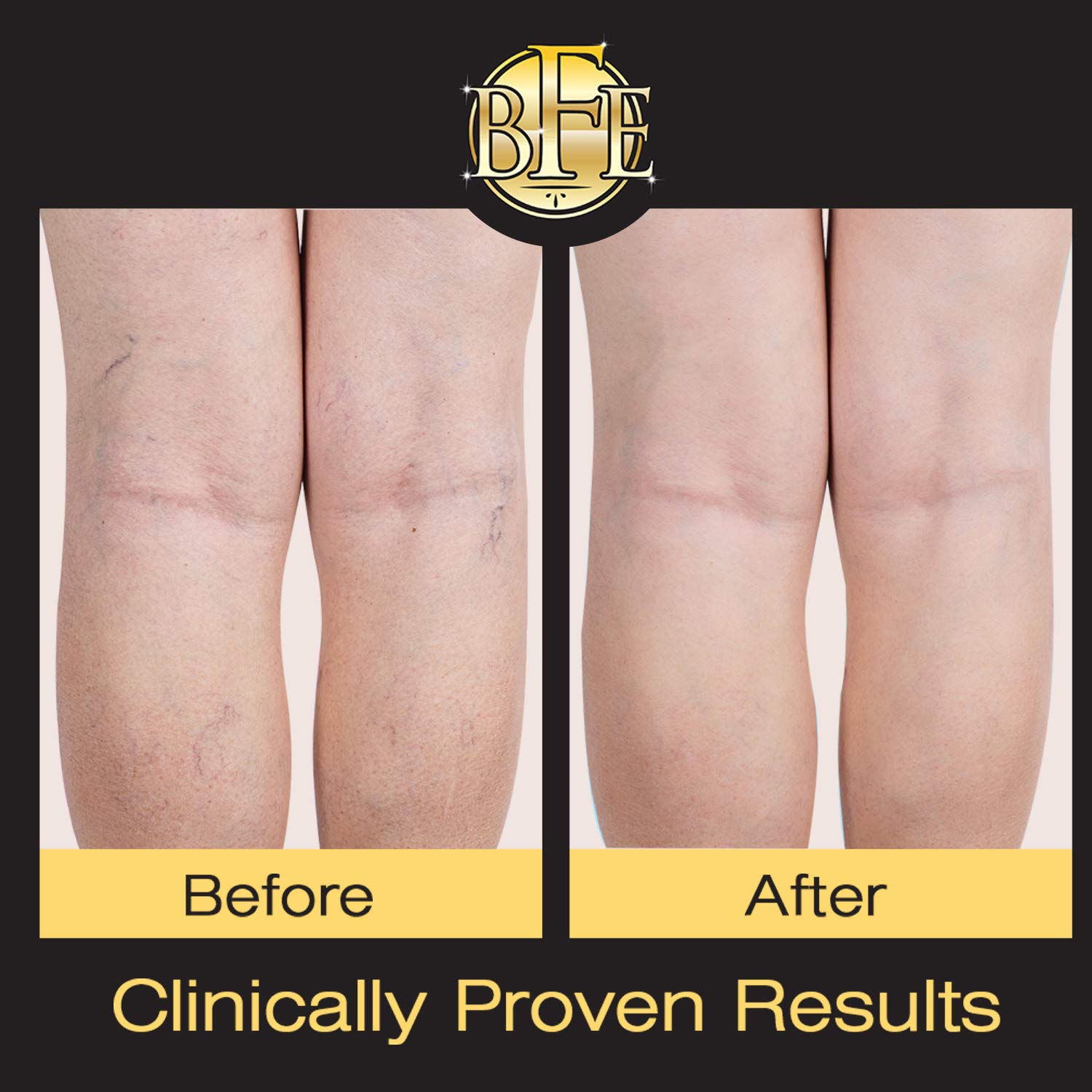 Vitamin K Cream Moisturising Bruise Healing Formula. Dark Spot