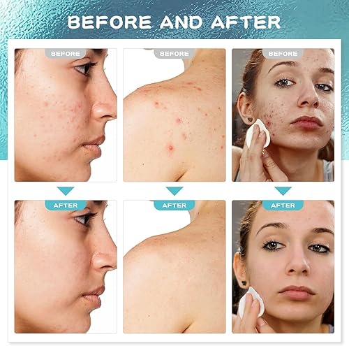Miniatura 2 de Tratamiento del acné para la cara: suero de ácido salicílico para hombres y mujeres propensos al acné - Crema de espinillas para la espalda del