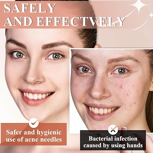 Miniatura 4 de Kit de 8 herramientas para eliminar puntos negros, juego de eliminación de acné de acero inoxidable de grado médico con pinzas y agujas, extractor