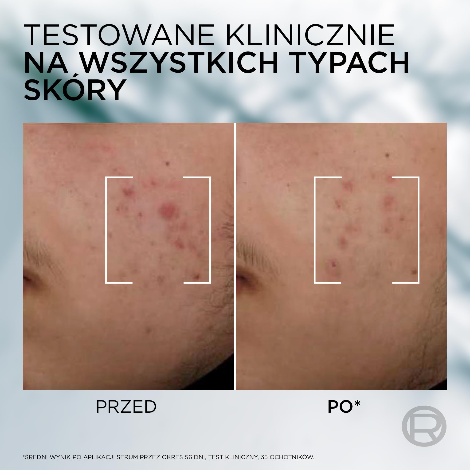 L'Oréal Paris Men Expert Derma Control Serum Przeciw Niedoskonałościom z Niacynamidem, 30 ml