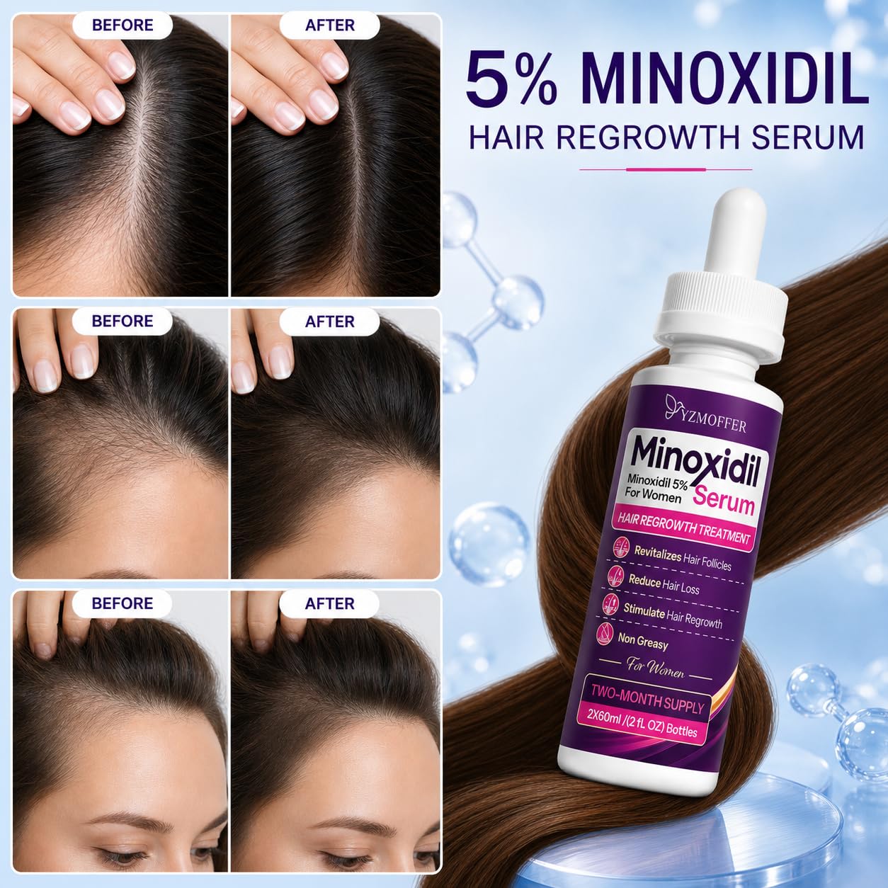 Yzmoffer Minoxidil 5% Hair Regrowth Treatment for Women, Topical Serum Drops for Thinning Hair, Revitalizes Hair Follicles, Reduces Hair Loss, Non-Greasy Liquid Formula, 2-Month Supply