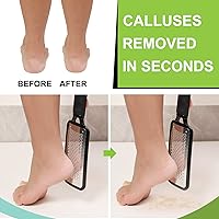 Vista 2 de Colossal - Lima de pedicura para pies, removedor de piel seca y callos para pies, removedor de piel dura y piel muerta para pies, removedor