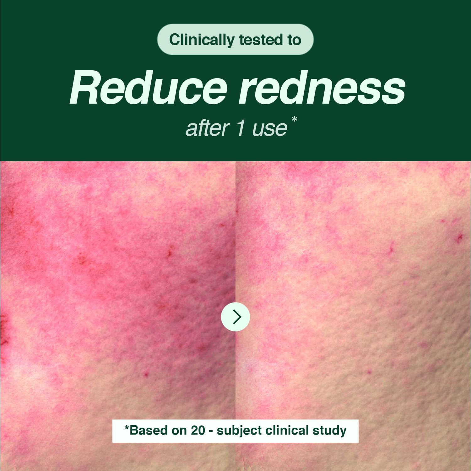 Tea Tree Foam Cleanser - Gentle Face Wash with Creamy Foam Texture & Hyaluronic Acid, BHA for Deep Pore Cleansing, For Oily & Sensitive Skin ,Korean Skin Care(150ml / 5.07 fl.oz) - Image 3